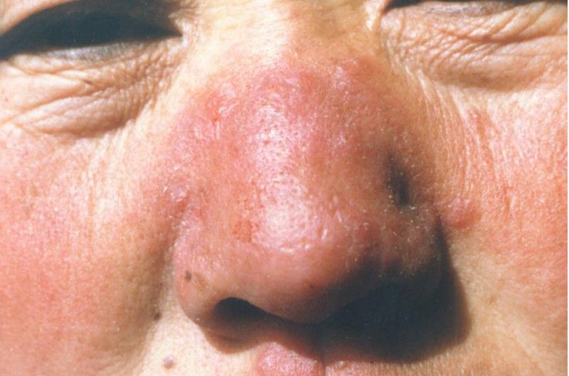 酒糟鼻的症状图片