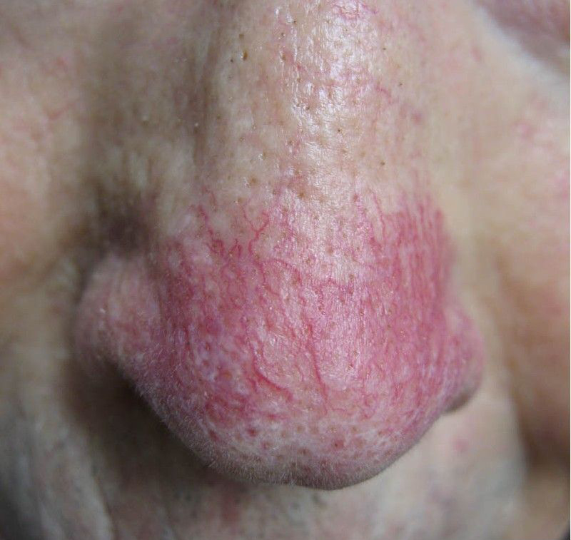 酒糟鼻的症状图片