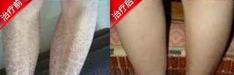 鱼鳞病 案例