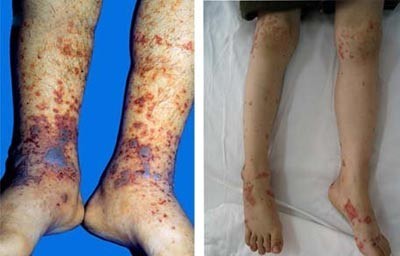 过敏性紫癜的危害