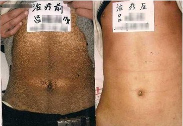鱼鳞病治疗前后对比
