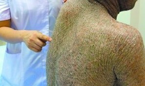 鱼鳞病的症状