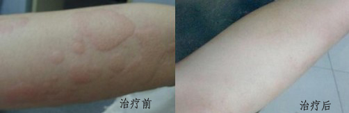 患者治疗后局部症状表现