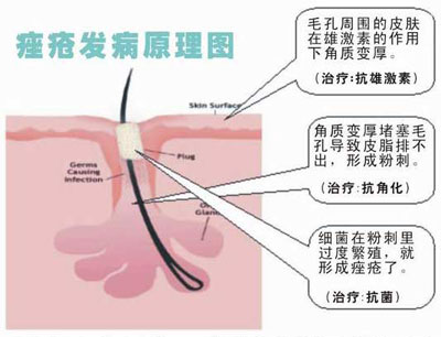 青春痘形成过程