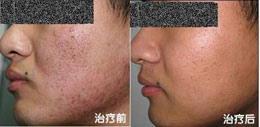 青春痘治疗前后对比