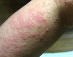 ����ʪ��֢״