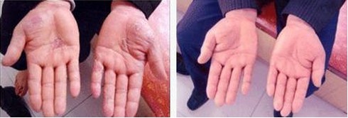 患者治疗后症状明显好转