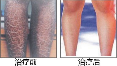 鱼鳞病治愈案例