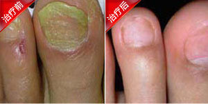灰指甲治愈案例