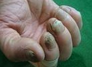 灰指甲