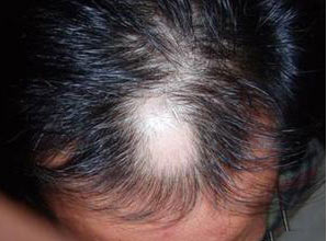 斑秃治疗