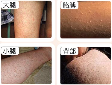 毛周角化症状