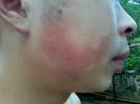 换季性皮肤过敏