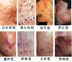 青春痘图片