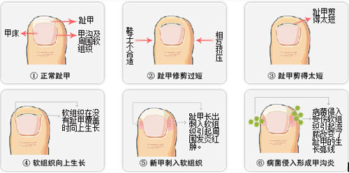 易得甲沟炎是什么原因 危害大吗