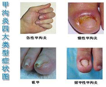 甲沟炎的症状 看图识病更清楚