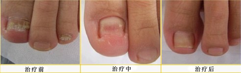 甲沟炎的治疗方法在哪家医院好