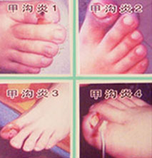 甲沟炎症状