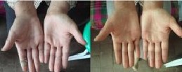 手足癣案例