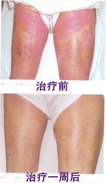 股癣病例