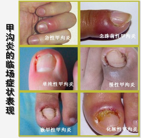 甲沟炎的临场症状表现图