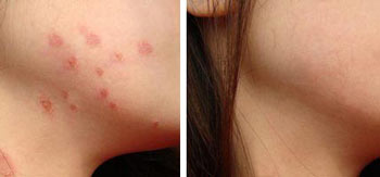 玫瑰糠疹治愈案例