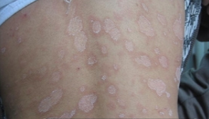 玫瑰糠疹症状图片