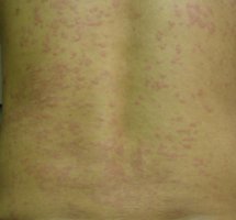 荨麻疹YAO物的副作用