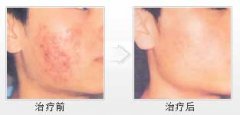 青春痘在临床上有哪些表现症状?