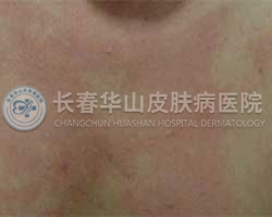 什么是胆碱性荨麻疹?有哪些发病特点呢?